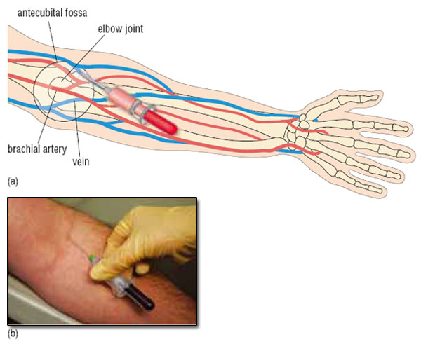 Diabetes Complications Figure 7 A Diagram Of Veins In A Forearm Showing The Antecubital Fossa Area Where Blood Samples Are Taken B Venous Blood Sample Being Taken From A Vein In The