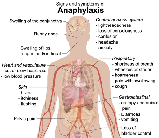Diagram of a human body with the heading: Signs and symptoms of anaphylaxis.