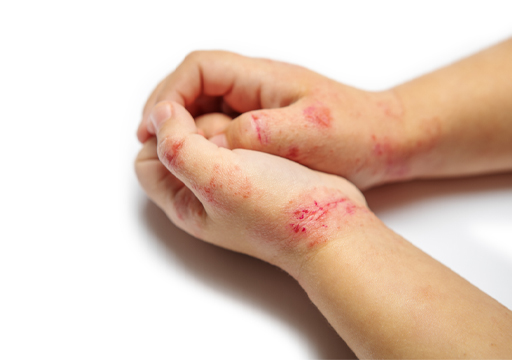 This shows a child’s hands covered in eczema.