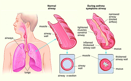 Diagram of two airways: one normal airway, one during asthma symptoms airway
