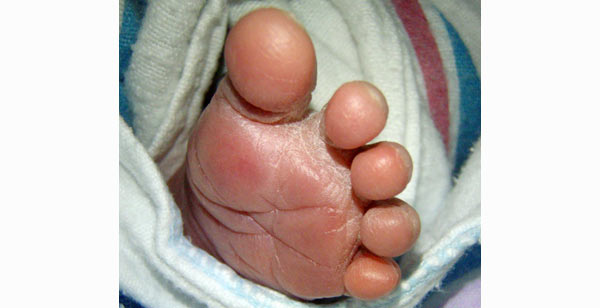 Baby's foot [Image:Daquella manera under CC-BY licence]