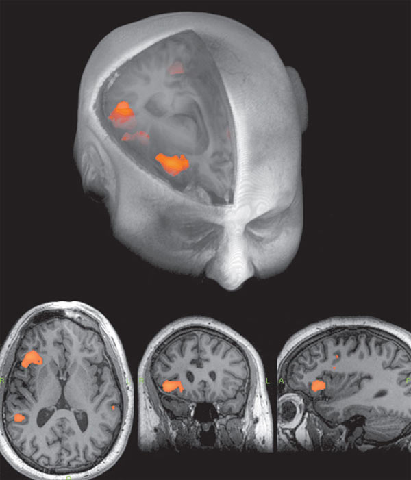 An fMRI scan showing with areas of increased activity highlighted. [Image courtesy of GE Healthcare]