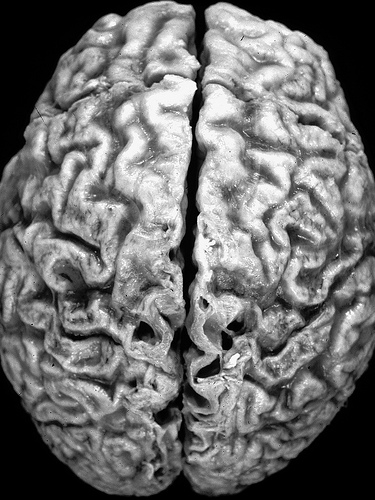 A brain affected by Alzheimer's disease