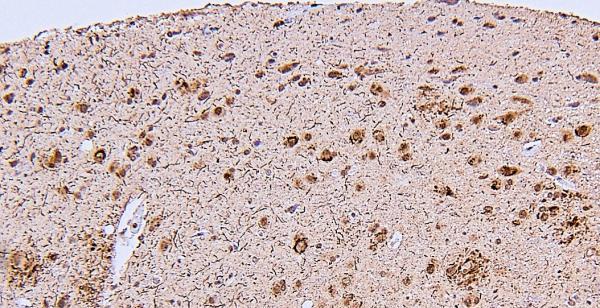 Biopsy from a brain showing early stages of Alzheimer's Disease
