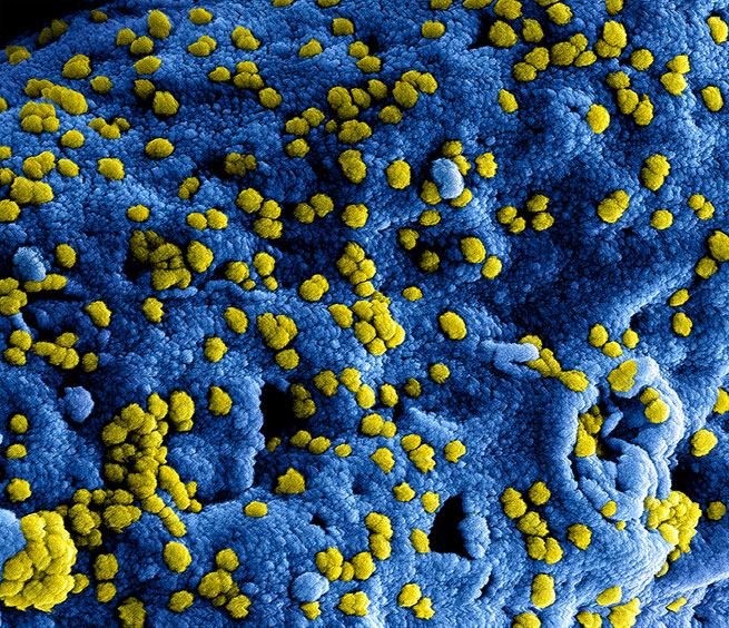 Colorized scanning electron micrograph of Middle Eastern Respiratory Syndrome virus particles attached to the surface of an infected VERO E6 cell.