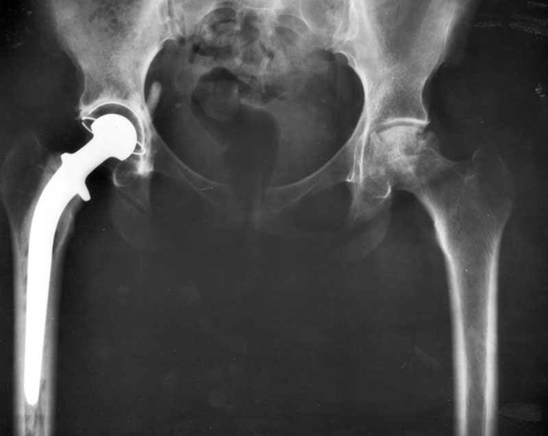 An X-Ray showing hip replacements