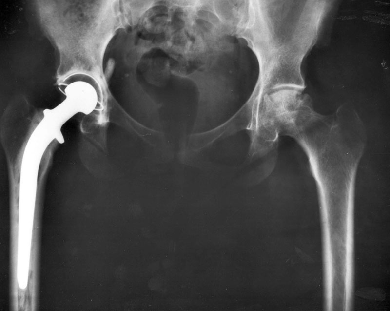 An X-Ray showing hip replacements