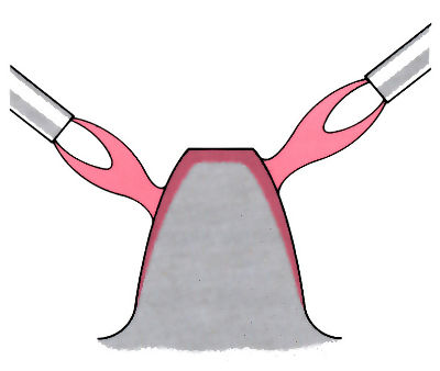 Images to demonstrate 'Induction/flame hardening' - see article