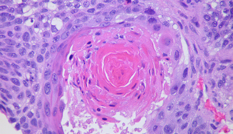 Squamous cell carcinoma Case 113