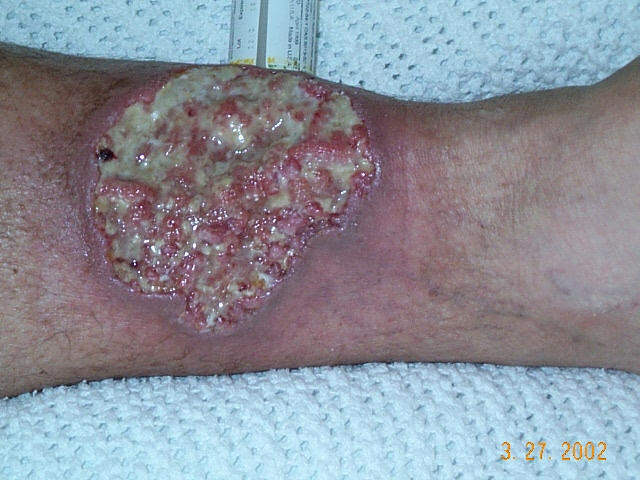 Crohnie Pyoderma gangrenosum.0000000000