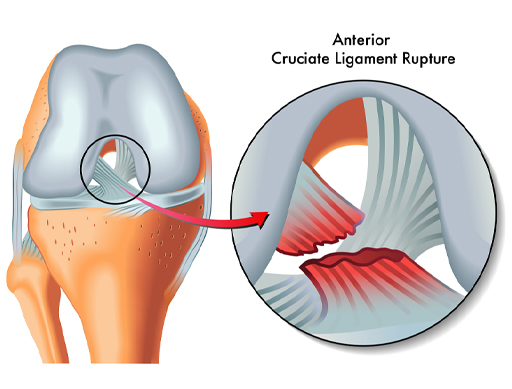 The image shows two representations of the knee. On the left is the knee joint where the ends of the two bones, femur and tibia, that form the knee joint are shown. Also shown is the anterior cruciate ligament that attaches to the femur and the tibia. On the right the focus is on the anterior cruciate ligament, and it shows a tear to the anterior cruciate ligament.