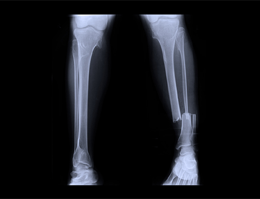 The image shows an X-ray of the lower leg. The tibia and fibula bones are seen and on the right leg there are fractures to tibia and fibula bones.