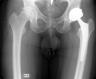 Hip replacement surgery: routine or rationed?