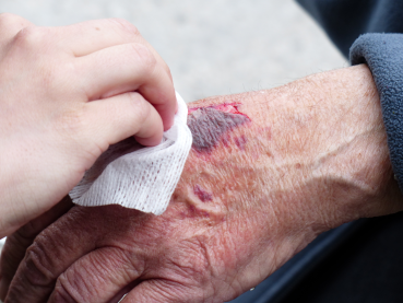 An overview of wound care