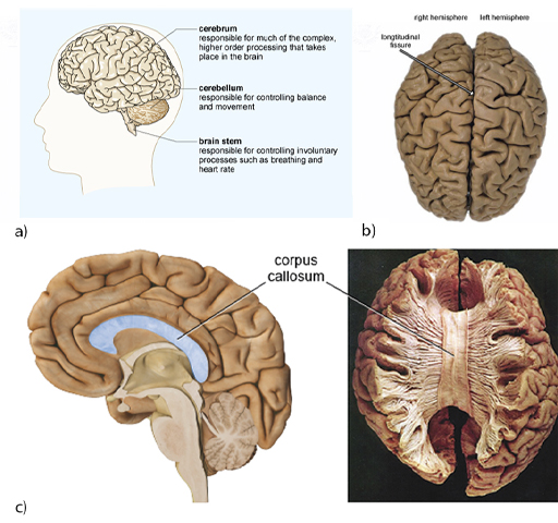 This is a collage of four images of the human brain, all showing that it has a walnut-like appearance of ridges and grooves across its surface. Figure 1 (a) is a diagram of a human brain located inside a head, showing the large cerebrum occupying most of the skull, with the smaller cerebellum underneath the back of the cerebrum, and the brain stem emanating from under the cerebrum, just in front of the cerebellum. The cerebrum is responsible for much of the complex, higher order processing that takes place in the brain, while the cerebellum is responsible for controlling balance and movement. The brain stem is responsible for controlling involuntary processes such as breathing and heart rate. Figure 1 (b) is a colour photograph of the human brain, viewed from above. The two semi-oval (in the photograph) cerebral hemispheres are visible, right and left, with the longitudinal fissure between them. The surface of the brain (grey in the photograph) shows extensive gyri and sulci (ridges and grooves). Figure 1 (c) contains two images. The left image shows a sagittal view of a model of the human brain with the front of the brain towards the left and the back of the brain towards the right. The corpus callosum is highlighted as an elongated c-shaped structure, rotated 90 degrees clockwise and it sits just below the cerebral cortex. The anterior is almost level with the pituitary gland and the posterior is level with the back of the brain stem. It therefore occupies the middle region of the brain, from front to back. The right image in Figure 1 (c) is a colour photograph of a post-mortem human brain sample, viewed from above, with the top layer of cortex removed to show the thick band of the corpus callosum with numerous fibres projecting laterally across the midline of the brain from one hemisphere to another.