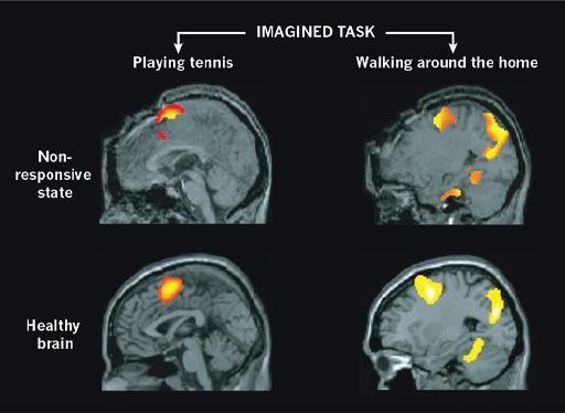 Four images taken by an fMRI scan are shown. These are greyscale images of brain tissue with some regions of red, orange and yellow superimposed on top showing regions of brain activity. Each is a side view of a human brain inside a head, looking to the left. The two images on the left are from different patients imagining playing tennis, while the two images on the right are from patients imagining walking around the home. In each case one patient has a healthy brain and the other patient is in a non-responsive state. For each imagined task, the regions of brain activity are very similar in both patients.