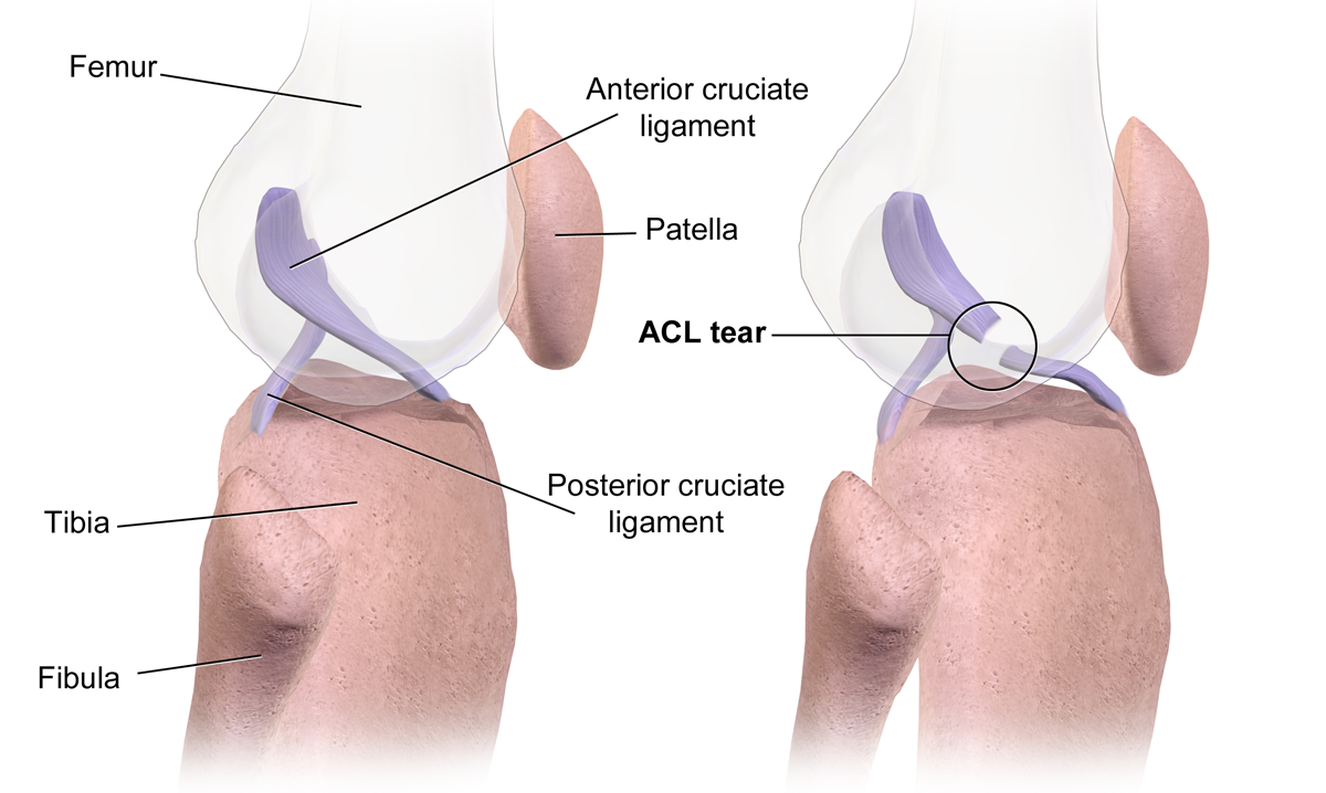An image showing an ACL tear in the knee.