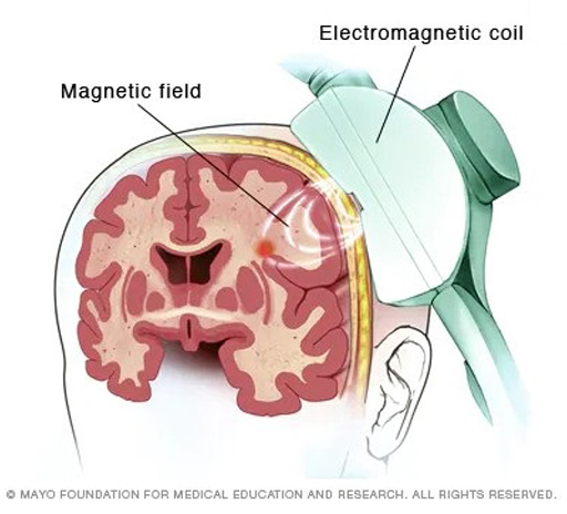 A cutaway image of a head and brain is seen. Held against the head is a device with an electromagnetic coil. Dotted arced lines indicate an invisible magnetic field penetrating the brain about halfway to its centre, with a single point in red indicating a point of focus in the brain tissue.