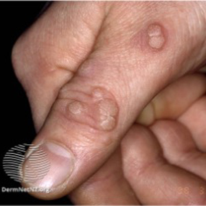 Photograph of a hand with warts.