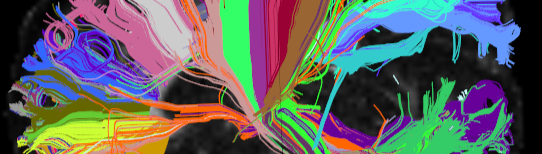 High Angular Resolution Diffusion Image of human brain