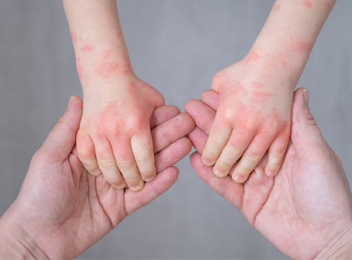 An image of a child’s hands with red marks
