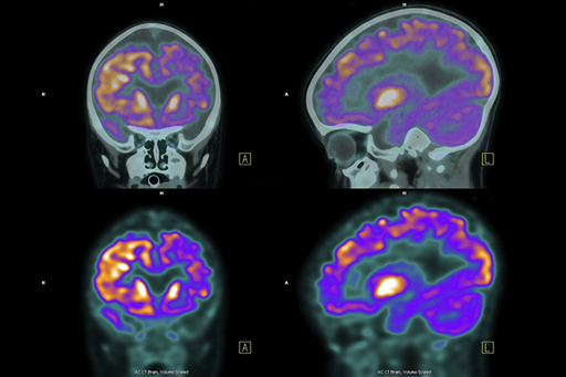 This shows four scans of a brain.
