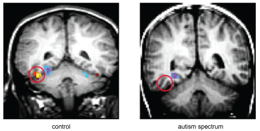 Two side-by-side fMRI images show the right and left cerebral cortex, and the cerebellum.