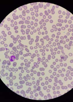 Malaria plasmodium vivax under the microscope