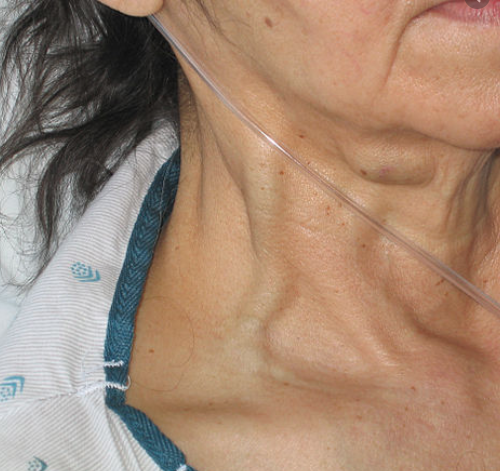 Woman on Nasal Cannula Oxygen