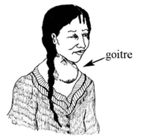 A woman with goitre