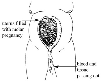 Blood and tissue passing out due to a molar pregnancy (tumour) growing in the uterus