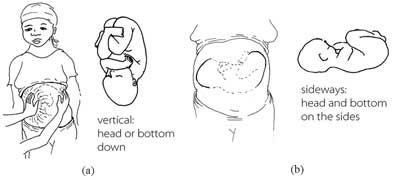 Feeling a mother’s belly. (a) is vertical, head or bottom down. (b) is horizontal, head or bottom on the sides