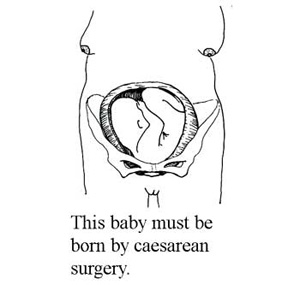 Baby is lying transverse and must be born by caesarean surgery