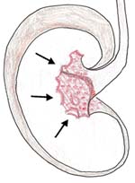 A kidney with a red area and arrows pointing towards it. This represents kidney infection.