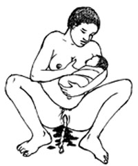 A woman has just given birth and is breastfeeding her newborn baby. You can see the umbilical cord hanging out of her vagina and there is blood also.