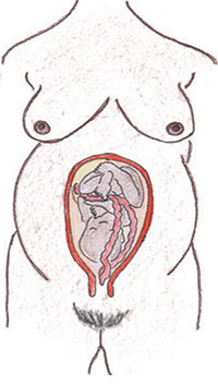 This picture shows a naked pregnant woman and the position of the baby in the womb. It shows a prolapsed cord.