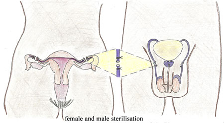 Female and Male sterilisation.