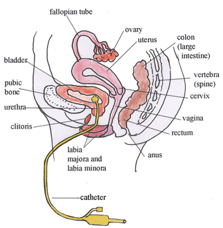 Half section of the pelvic cavity of a woman showing a urinary catheter anchored in the bladder by the inflated catheter balloon.