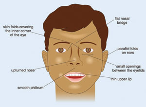 Characteristic facial features in a child with fetal alcohol syndrome
