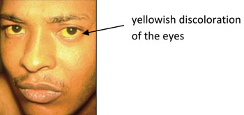 Yellowish colour in the white part of the eye due to hepatitis B.
