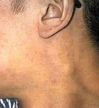 PGL on the left side of the neck.