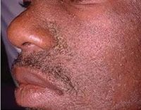 Scaly skin rash on the face, mainly around the nose, caused by seborrhoea.