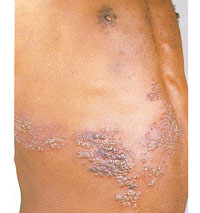 Vesicles around the lower chest area, caused by herpes zoster.