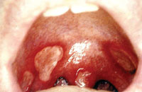 Recurrent aphtous ulcers on the upper part of the mouth.