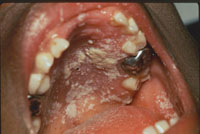 White patches in the mouth caused by oral thrush.