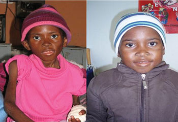 The before and after photos of a south African boy who has received ART.