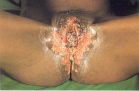Extensive ulcers and sores caused by Herpes genitalis.