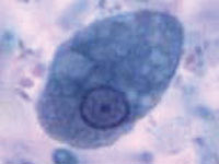 Entamoeba hystolica magnified over 1,000 times