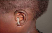 Pus discharge as a result of chronic otitis media