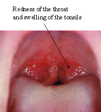 Sore throat and swollen tonsils